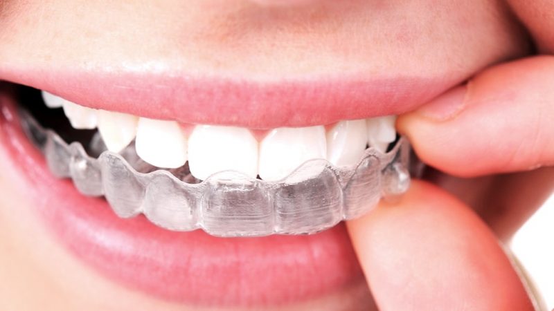Important Things About Invisalign Treatment