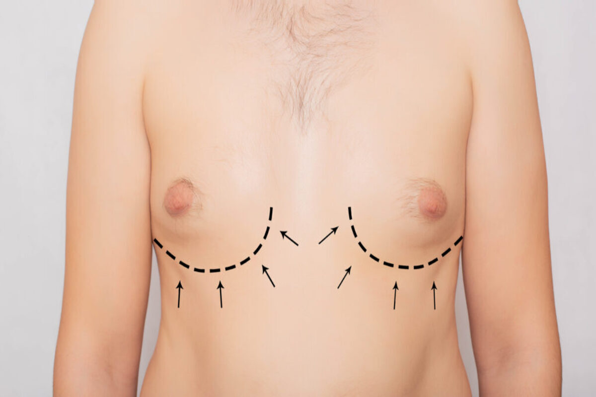 All You Have To Learn About The Best Gynecomastia Surgery